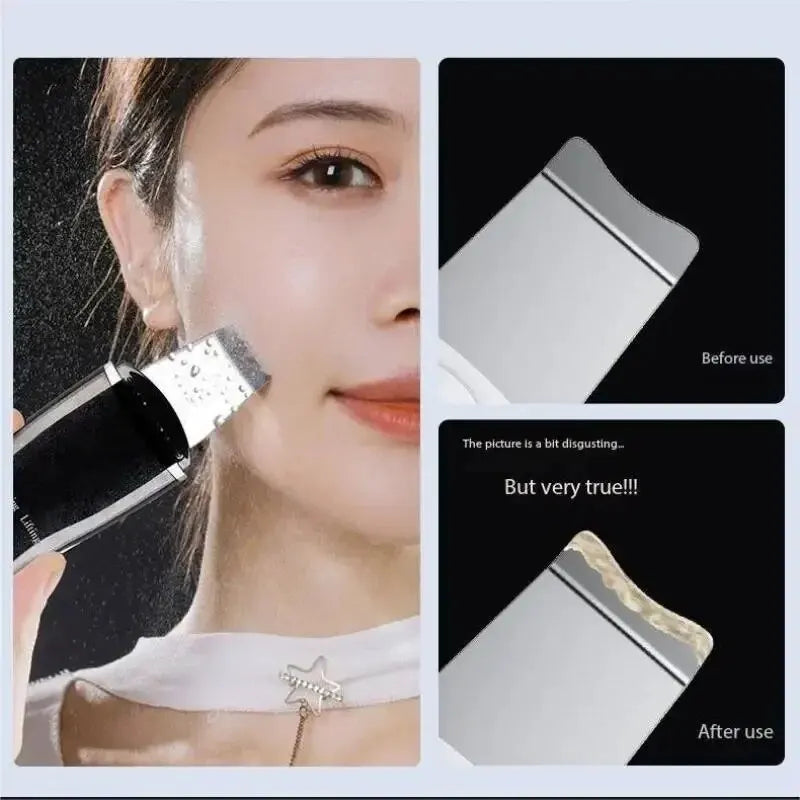 Blackhead Remover Beauty Tool